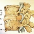 椎間板　解剖学　後屈　腰痛