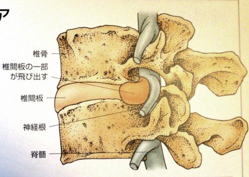 椎間板　解剖学　後屈　腰痛